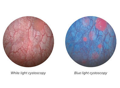 Image of the use of blue light cystoscopy.