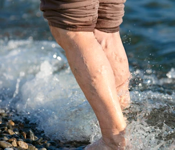 Unveiling the Truth About Varicose Veins: Top Myths Debunked