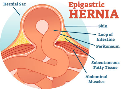 Illustration of a hernia.