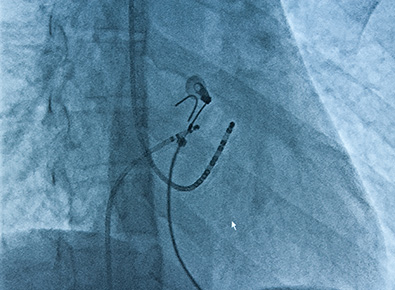 cardiac ablation