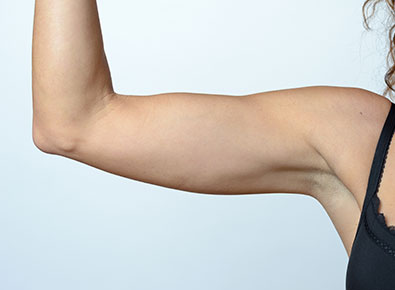 Woman's arm displaying procedure results.
