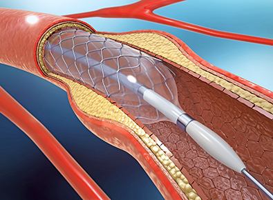 illustration of stent