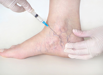 sclerotherapy