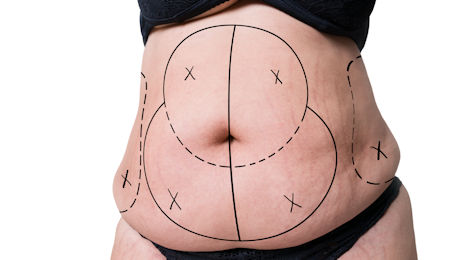 Types of Tummy Tuck Procedures and Scar Care