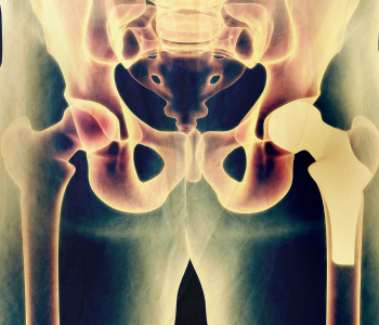 Why Choose Anterior Hip Replacement?