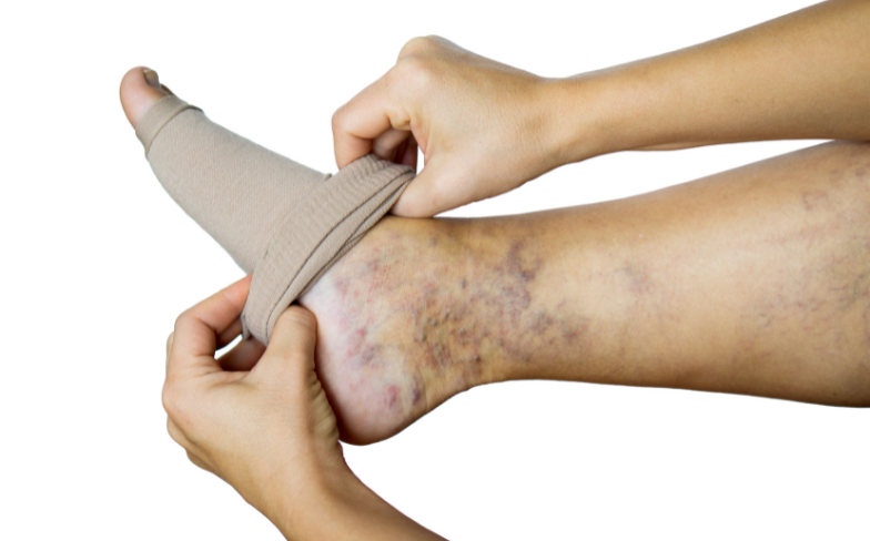 The Scope Blog - Medical Treatment for Varicose Veins - Tanner Health System