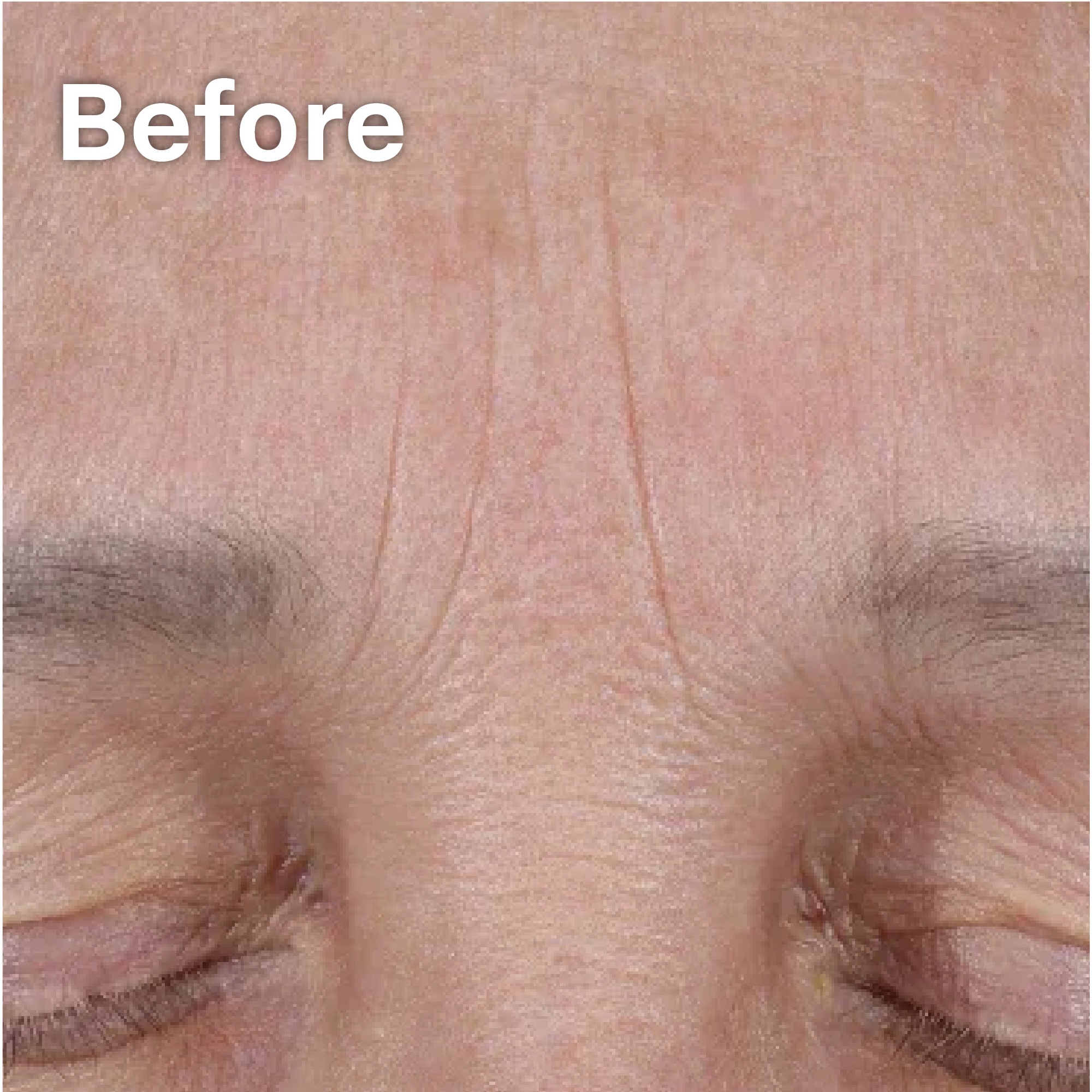 Elastiderm Before
