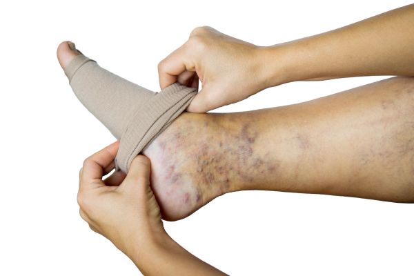 Compression stockings to avoid venous ulcers