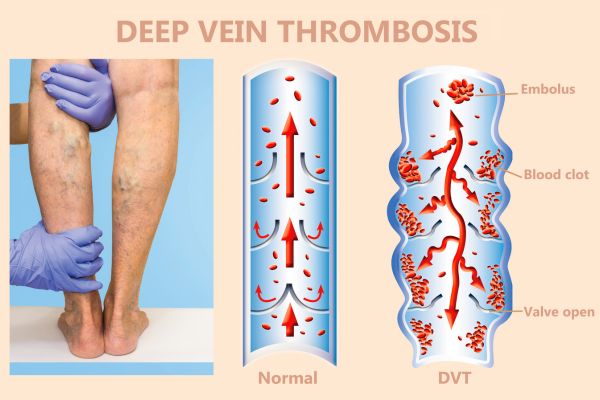 DVT in legs illustration