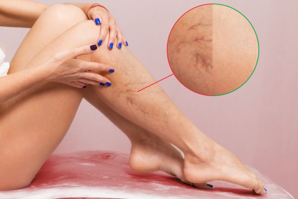 Woman with spider veins