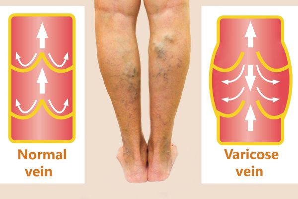 Varicose veins illustration